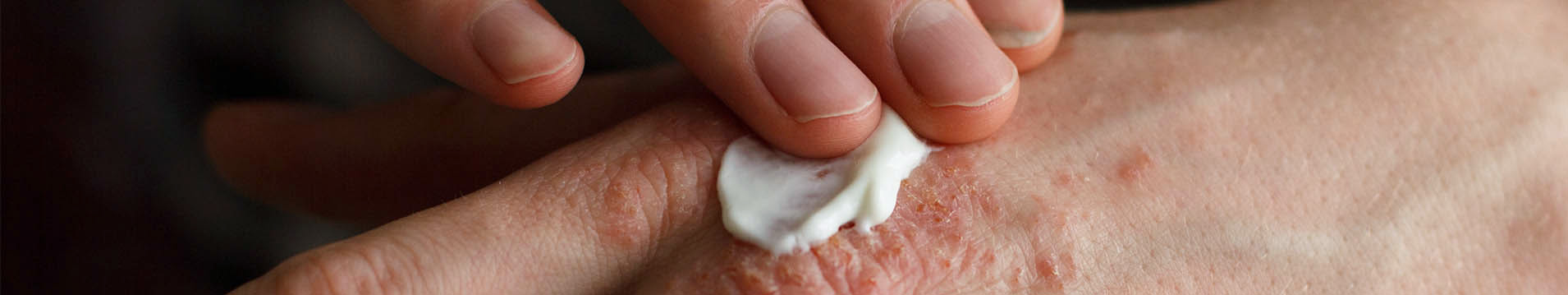 Image of Topical Cream Being Applied to Rash on Hand
